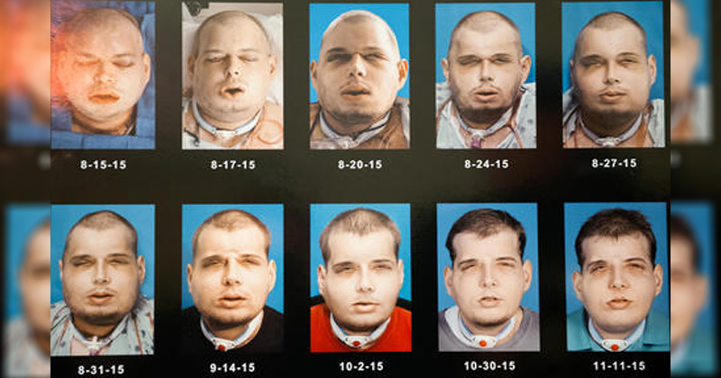 transplante-evolucion